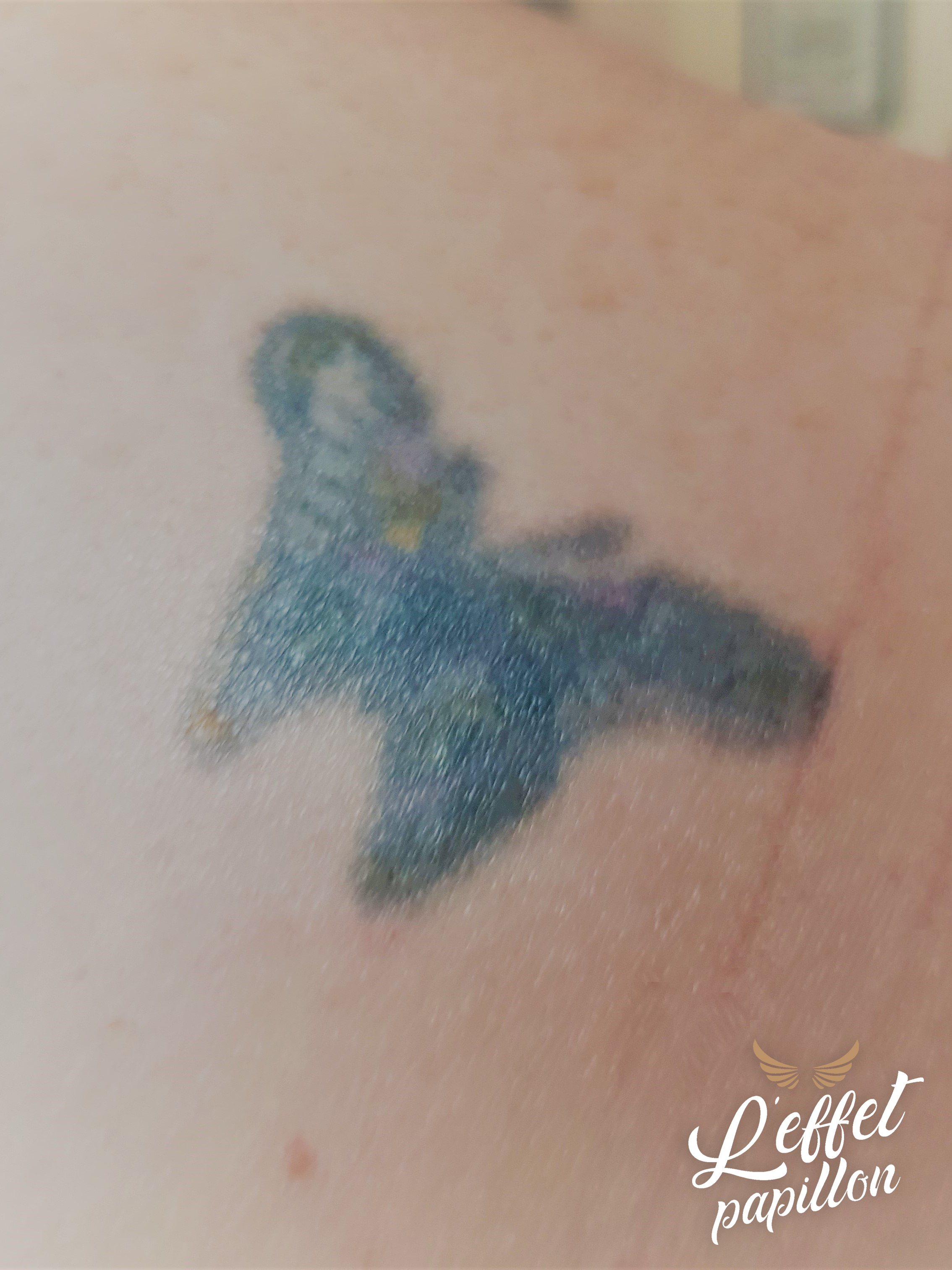 Photo détatouage laser